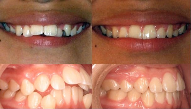 Crowding, flare teeth, overbite Jones family orthodontics smile