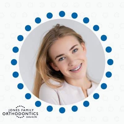 Dr. Jones explains indirect bonding 8 Indirect bonding