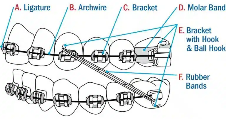 Braces_diagram_ Braces