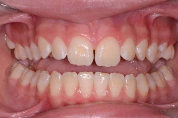 Amazing before and after results 18 Abby before treatment