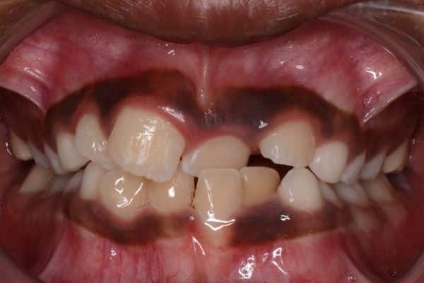 Amazing before and after results 20 Bhuvan before-treatment results