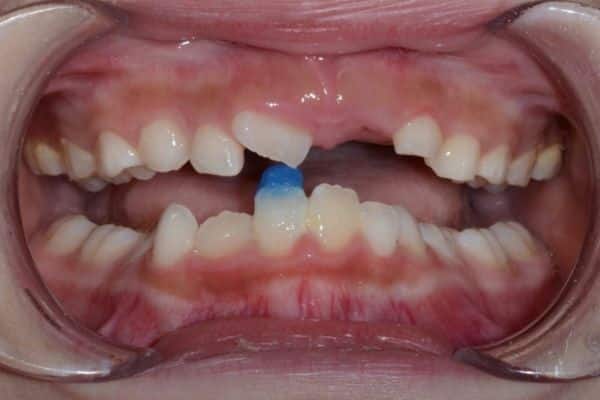 Amazing before and after results 22 Jazlin before-treatment results