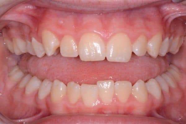 Amazing before and after results 24 Malia before treatment