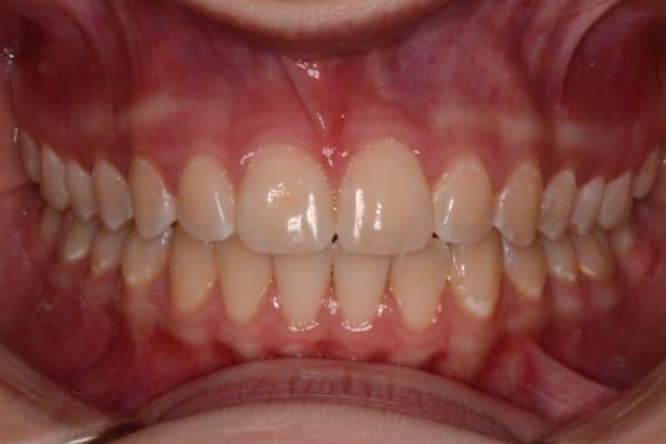 Amazing before and after results 19 Abby after-smile results