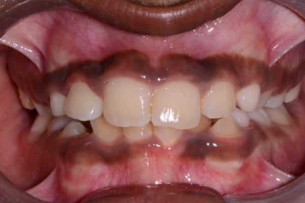 Amazing before and after results 21 Bhuvan after-treatment results