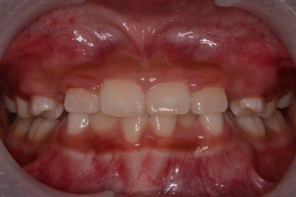 Amazing before and after results 23 Jazlin after-smile results