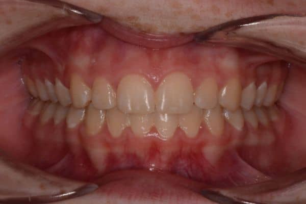 Amazing before and after results 25 Malia after treatment results