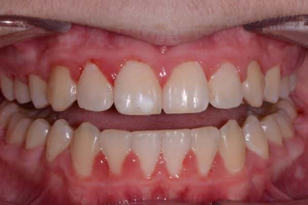 Amazing before and after results 17 Chad after smile transformation results teeth