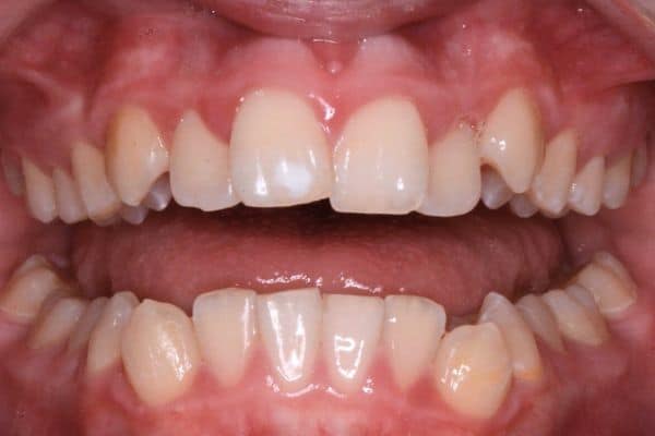 Amazing before and after results 16 Chad before smile transformation teeth