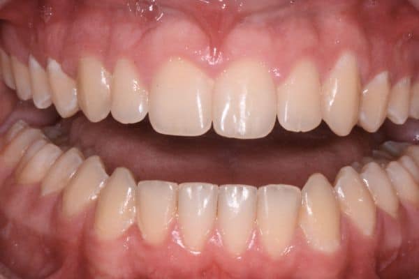 Amazing before and after results 13 Landen after smile transformation teeth