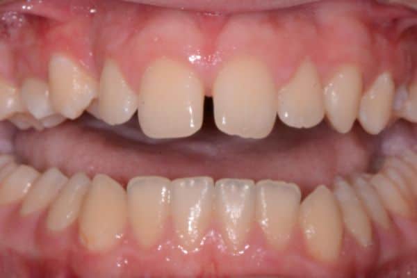 Amazing before and after results 12 Landen before smile transformation teeth