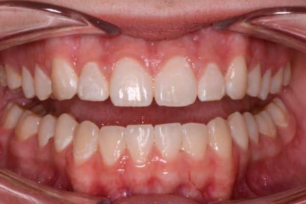 Amazing before and after results 15 Safe after smile transformation