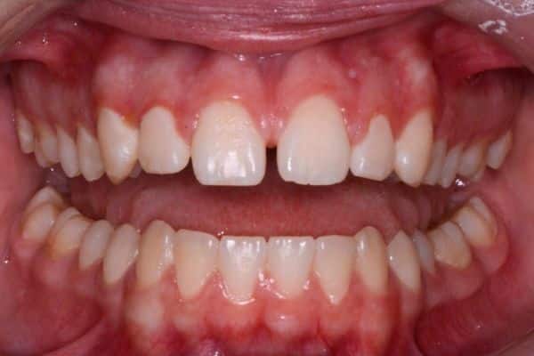 Amazing before and after results 14 Sage before smiles transformation teeth