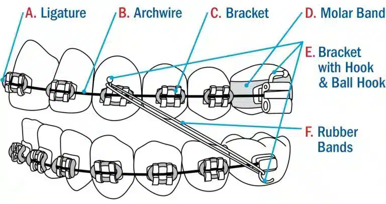 Achieving your best smile: a guide to braces 3 Illustration of braces and its components