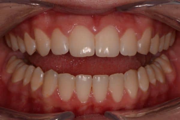 Amazing before and after results 3 Close-up of teeth following dental treatment