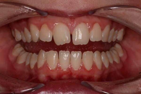 Amazing before and after results 2 Close-up of teeth prior to dental treatment