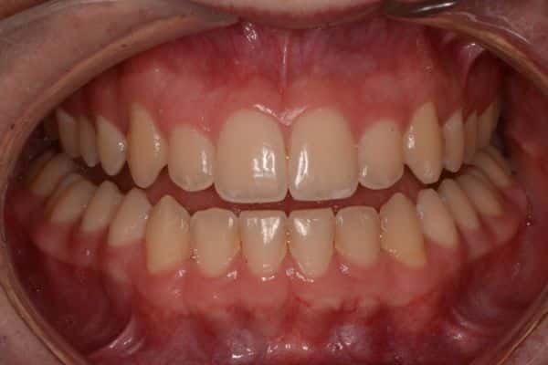 Amazing before and after results 5 Close-up of teeth after dental treatment