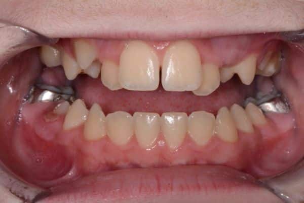 Amazing before and after results 4 Close-up of teeth before dental treatment