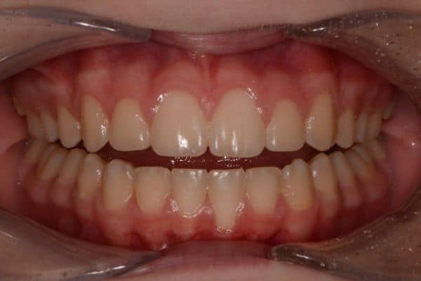 Amazing before and after results 11 Close-up of teeth after smile transformation
