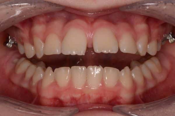Amazing before and after results 10 Close-up of teeth before smile transformation
