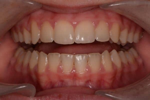 Amazing before and after results 7 Close-up showing teeth after cosmetic dental treatment