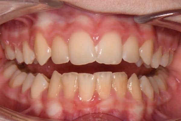 Amazing before and after results 6 Close-up showing teeth prior to cosmetic dental treatment.