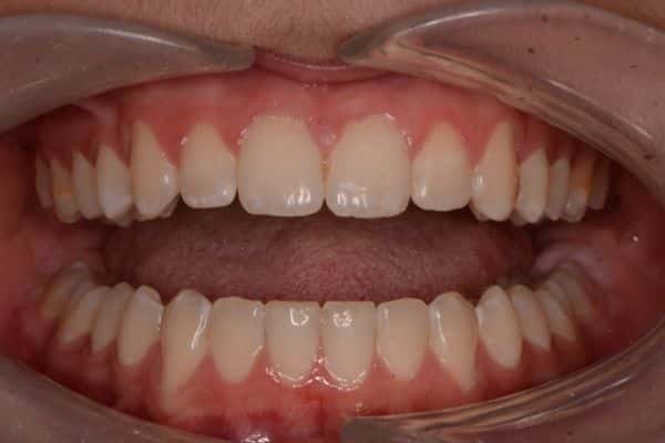 Amazing before and after results 9 Close-up of teeth after smile transformation treatment