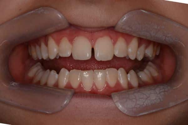 Amazing before and after results 8 Close-up of teeth before smile transformation treatment